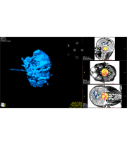 tumor